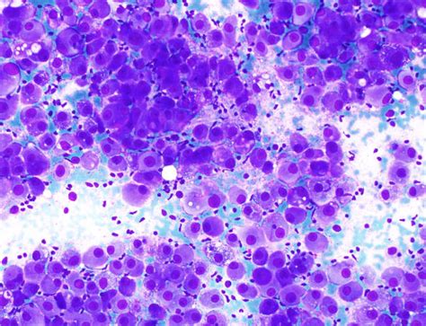 Hepatocellular Carcinoma Cytology