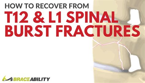 How Can I Treat a T12 or L1 Thoracic Spinal Burst Fracture?