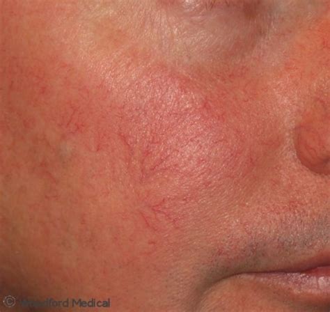 Facial Redness, Rosacea And Blushing | Woodford Medical