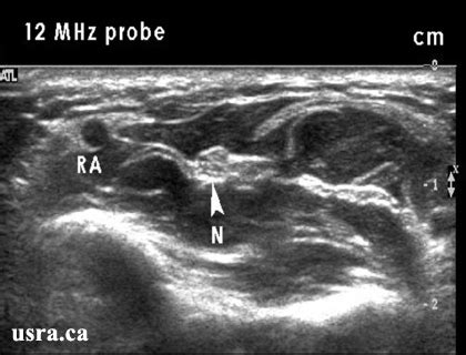 Radial Nerve: Ultrasound Radial Nerve Block At Elbow