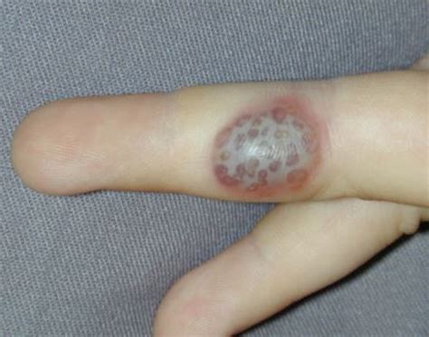 Herpetic Whitlow - Pictures, Treatment, Symptoms, What is?, Finger