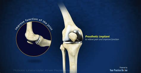 Robotic Unicondylar Knee Replacement - Michigan Knee Institute