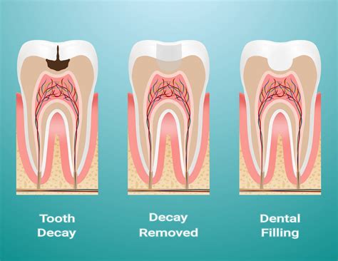 Restorations in Composite - Orozen Dental Clinics