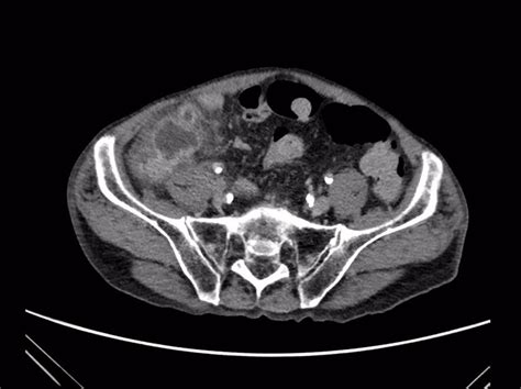 Peritoneal Abscess Appendix