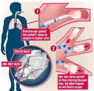 PulmonX Endobronchial Valve EBV Therapy – Compass Medical