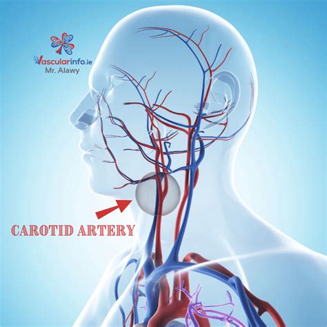 Carotid Endarterectomy - Vascular Info