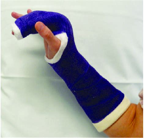 Ulnar Gutter Splint