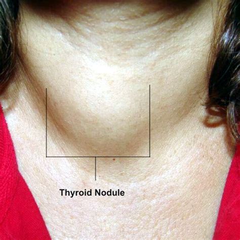 47 best Thyroid Nodules images on Pinterest