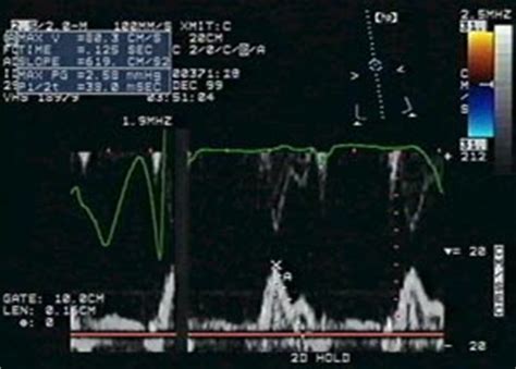 Echocardiogram: Procedure, Preparation & Duration