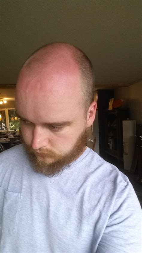 I miss when my hair would protect me from sunburn... Also, probably time to Bic it hey? : r/bald