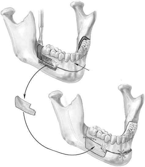 COMPLETE MANDIBULAR SUBAPICAL OSTEOTOMY | Pocket Dentistry