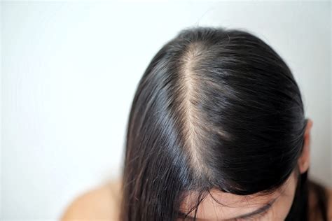 Popular Female Pattern Baldness Treatment - Dillon Hair Restoration in Schaumburg, IL 60173