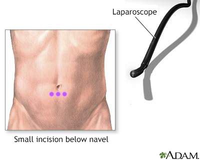 Diagnostic laparoscopy Information | Mount Sinai - New York