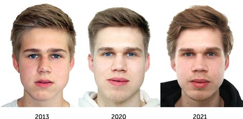 Asymmetrical Face Surgery Before And After