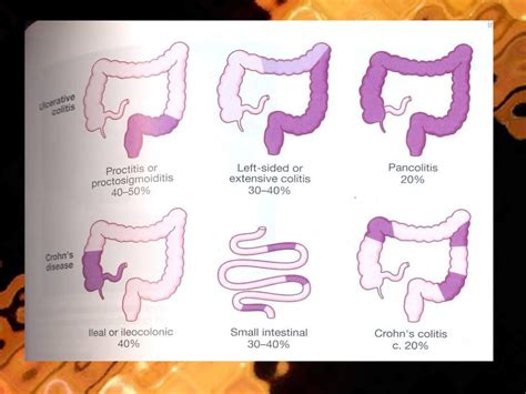 INFLAMMATORY BOWEL DISEASE