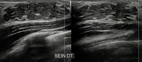 Premature thelarche (bilateral and asymmetrical) | Image | Radiopaedia.org