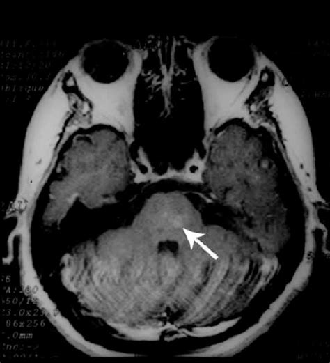 Unruptured capillary telangiectasia of the brain stem. Axial T1 weigted... | Download Scientific ...