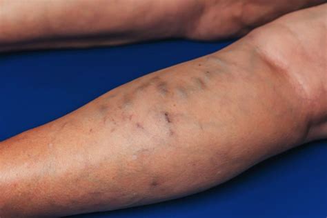 What is phlebitis, and what’s the best treatment? : Vascular Solutions ...