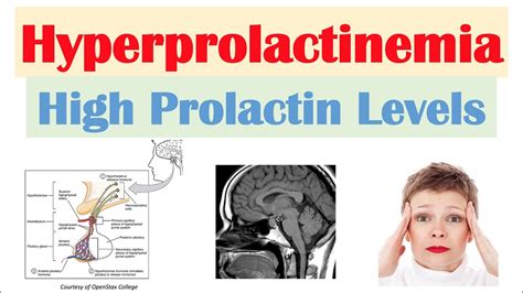 Hyperprolactinemia (High Prolactin Levels) | Causes, Signs & Symptoms ...