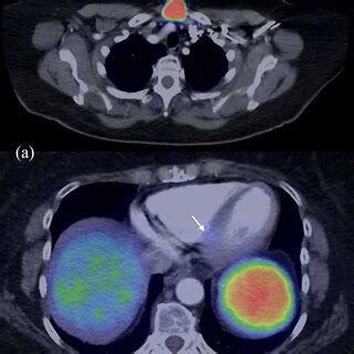 DOTA PET/CT demonstrating avidity in the midline neck mass (a) and the... | Download Scientific ...