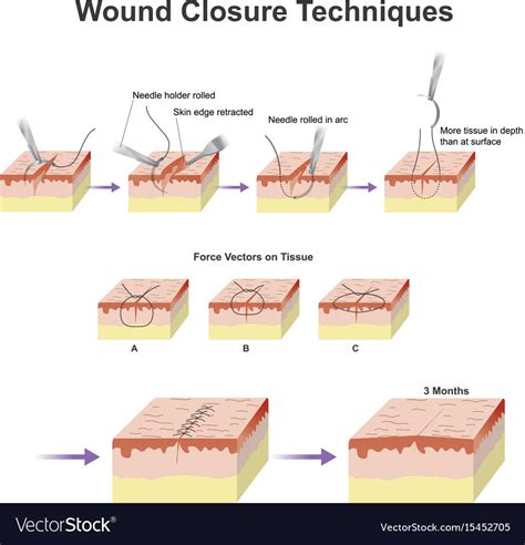 Types Of Wound Closure - Catalog Library