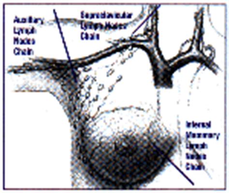 Sentinel Lymph Node Biopsy - Imaginis