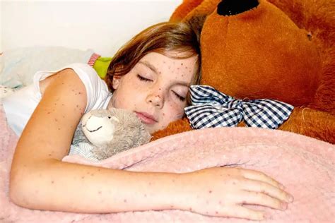 Measles: Signs and Symptoms - LaTouche