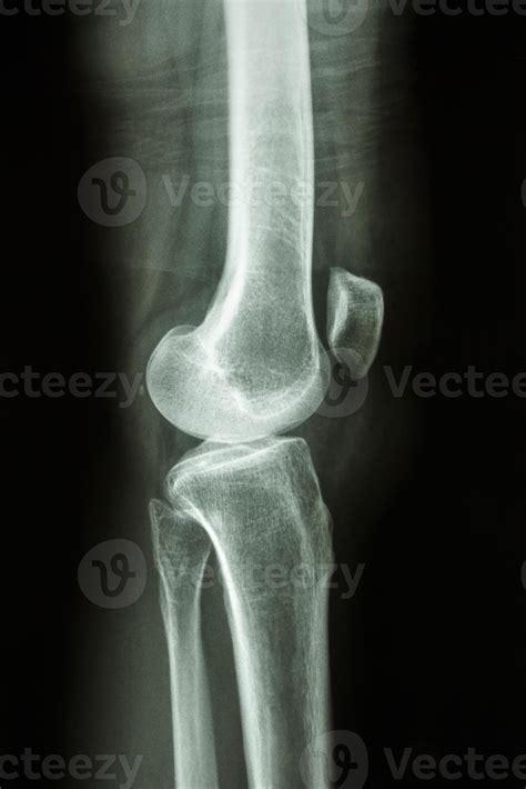 Film X ray knee lateral view show normal human s knee joint 2591219 Stock Photo at Vecteezy