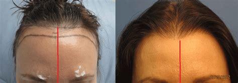 29+ Hair Transplant For Women - OmereOluyemi