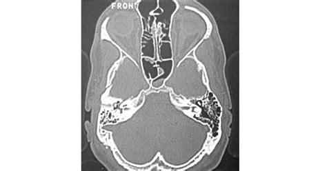 Fracture of Temporal bone - New