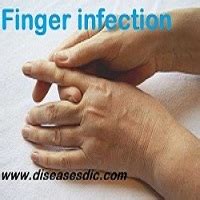 Finger Infection – Causes, Treatment and Prevention.