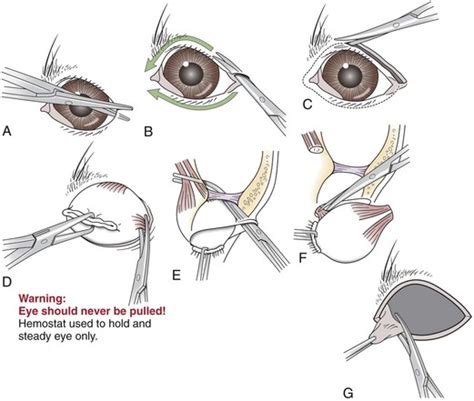 Surgery of the Eye | Veterian Key