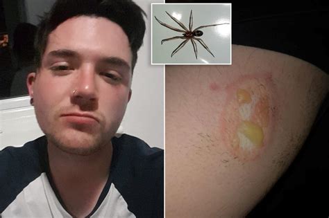 Spider leaves man with flesh-eating wound that won't heal