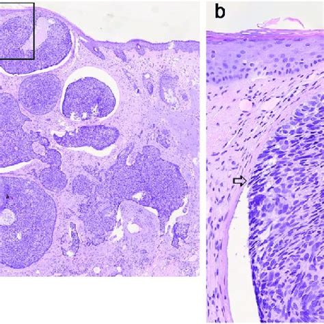 Histological overview showing a nodular BCC (nodulocystic variant) (a ...