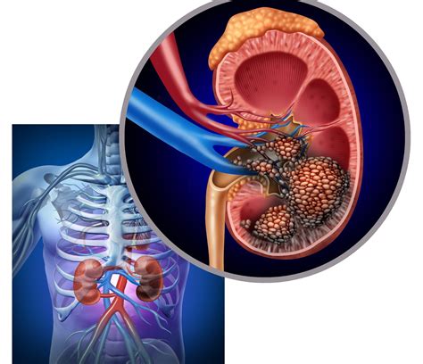 An Overview of Kidney Cancer - symptoms, causes and treatment alternatives | CANCERactive