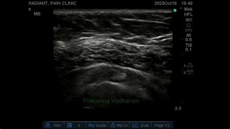 Glenohumeral Joint Injection -anterior approach Rotator interval - YouTube