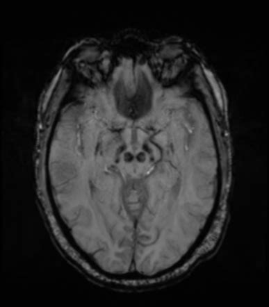 Mri Findings In Parkinson S Disease Radiographics