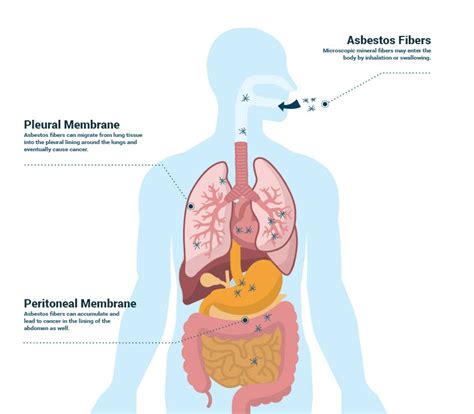 MESOTHELIOMA: CAUSES, SYMPTOMS, DIAGNOSIS, TYPES, STAGES, RISK FACTORS, KEY STATS - General ...