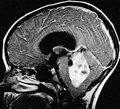 Ependymoma - Libre Pathology