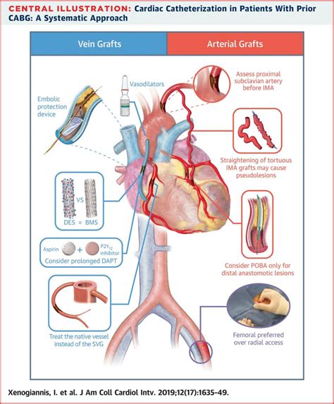 Update on Cardiac Catheterization in ... | Cardiac catheterization, Cardiac, Surgery nursing