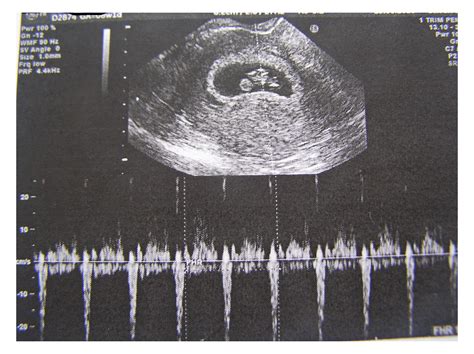 Ultrasound Scans in 9th Week of Pregnancy