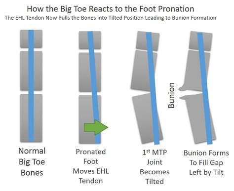 Bunions : Causes, Symptoms, And Treatment