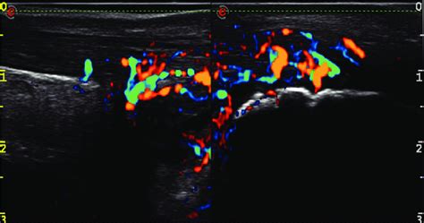 Achilles tendon enthesitis in a PsA patient (within 3 weeks since onset... | Download Scientific ...