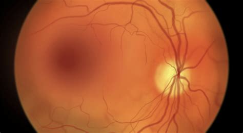 Diabetic Macular Edema: Symptoms and Treatment | Healthnews