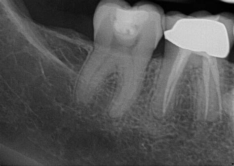 Root Canal Retreatment- Jensen Endodontics Inc