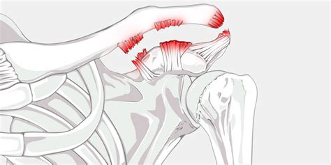 Shoulder Separation - The Complete Injury Guide — Vive Health