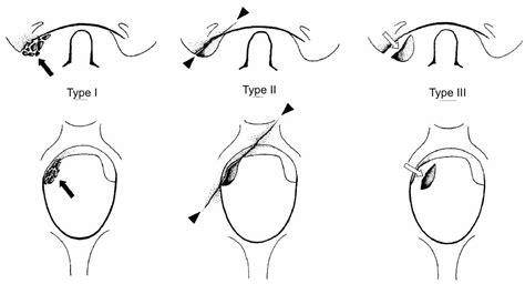 Occipital Condyle Fractures - Spine - Orthobullets