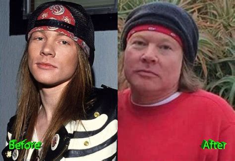 Axl Rose Plastic Surgery: A Bad Decision - Plastic Surgery Mistakes