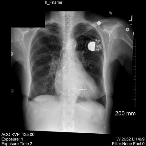 Handling Pacemakers in MRI - RITE Advantage