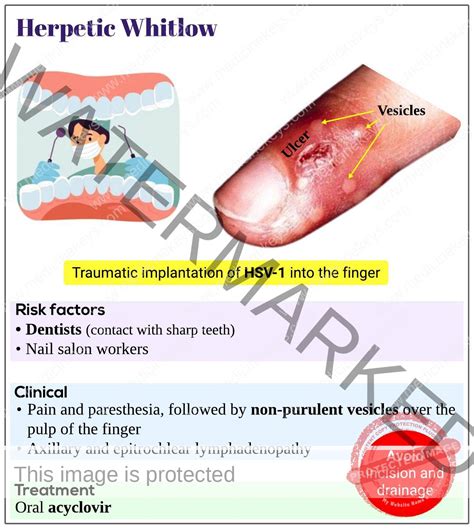 Herpetic whitlow - Medicine Keys for MRCPs